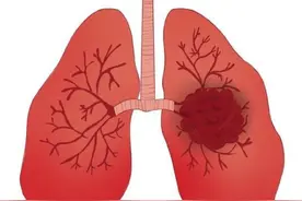 肺癌常用肿瘤标志物，您了解吗？图片