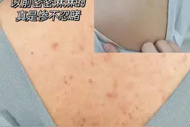 3年去除螨虫痘痘史分享！只需掌握这两招，后背秒变光滑肌！图片