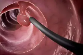 肠息肉切除后注意这几点 伤口恢复得更快图片