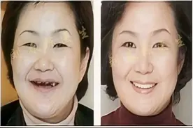 博士讲科普—种植牙后注意事项及护理要点，建议收藏图片