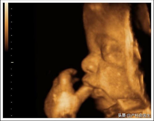 NT和四维哪个看胎儿性别更准确？产科医生告诉你真相