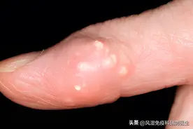 长出痛风石该怎么办？4种不同情况这样处理，千万别是第4种！图片