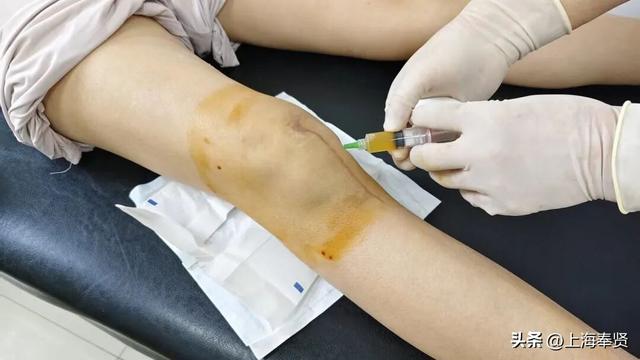 膝盖“重获新生”！PRP疗法让徒步达人再登山顶