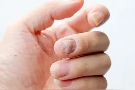 手指甲被砸掉了，还能长成原样吗？图片