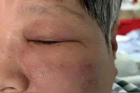 春季带状疱疹高发！小心后遗神经痛！图片