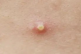 长了脓包型痘痘怎么办？会不会越来越严重？图片