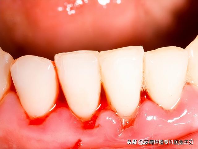 牙龈增生的原因和治疗方法