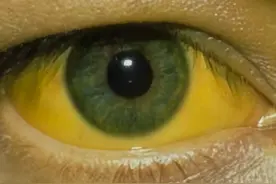 乙肝患者问：我已经服药11年了，如果这11年不治疗，我会死吗？图片