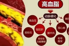 一年2次的“降脂针”，中国人群数据首出炉！打算自费的患者必看图片