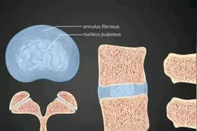 腰间盘膨出痊愈后，再去干重活，犯病了会比之前更严重一定吗？图片