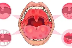 研究表明：牙膏一换，口炎几率少一半？建议用6种牙膏，自查更换图片
