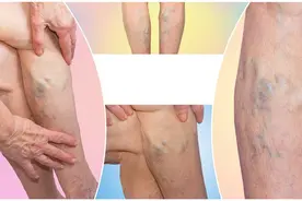 得了下肢静脉曲张怎么办？科学服用5种药物，改善下肢循环图片