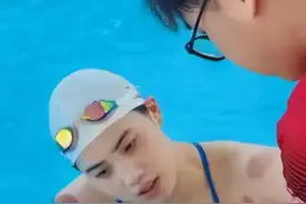 刚开始还说我们是“东方巫术”，现在是真香现场：老外沉迷拔火罐图片