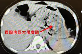 发现1例，5岁女孩确诊！多地已有病例，医生：要警惕这些异常图片