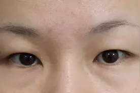 眶骨低、眼睛肿，做完双眼皮会显得凶吗？图片