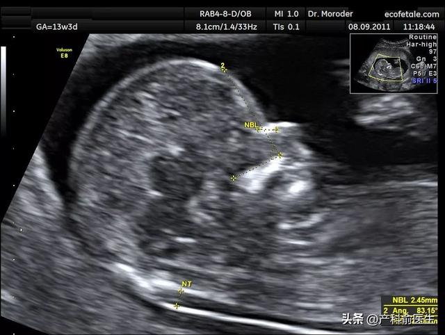 NT和四维哪个看胎儿性别更准确？产科医生告诉你真相