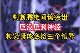 判断腰椎间盘突出，压没压到神经，其实身体就会给你三个信号图片