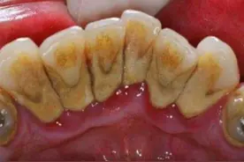 睡前不刷牙会发生什么？我们做了个实验，结果大为震惊……图片