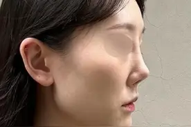 不远千里江苏到北京修复鼻子，术后的她惊喜的说：终于正常好看了图片