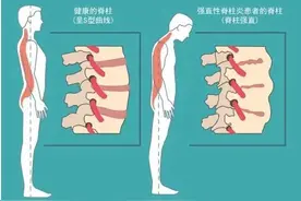 老是疼痛，是脊柱的气乱了，一个方子，为脊柱理理气！图片