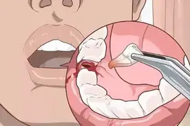 牙齿拔了以后可以一直空着吗图片