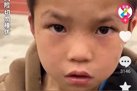 后续！广西熊孩子抓蛇带到学校，拔牙当宠物，看到他的伤疤惊呆了图片