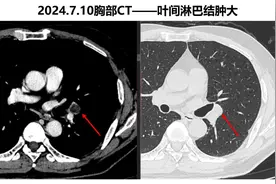 警惕肺癌中的天生小恶魔，就算不足1cm也很危险！图片