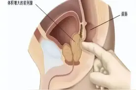 男性“小便”打湿鞋要重视，“尿无力”你了解多少？图片