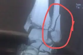 骨折后的真实感受，骨折挡灾？？？图片