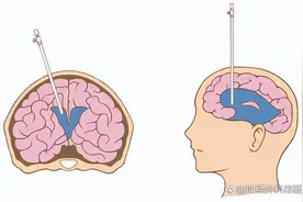 脑子进水了（脑积水）怎么办？能治吗？图片