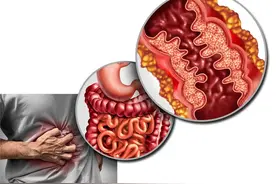 肠炎要如何用药？这6种药物可适用于肠炎！改善腹痛泄泻图片