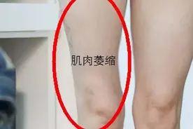 肌肉萎缩的病因，中医分型与治疗图片