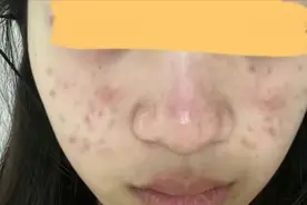 痘肌人公认好用的祛痘膏测评！这几款用完痘痘、痘印全消失！图片