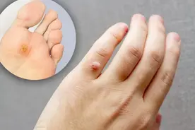 疣会否自然消失？ 皮肤科医生详解皮肤疣的4大种类图片