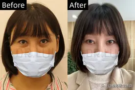 警惕！不要随便做眼袋切除，有些后遗症你接受不了！图片