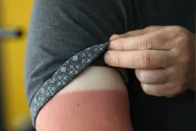 皮肤晒伤警告有哪些？如何修复和避免晒伤？快来领取你的夏日防护秘籍!图片