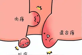 越来越多“有痔青年”，6个因素易引起痔疮，5个方法远离痔疮图片