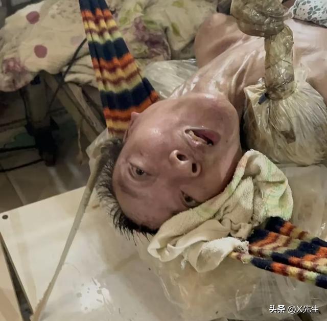解脱了！越南“蝴蝶宝宝”去世，20多根绳子绑在床上，挂了50多年