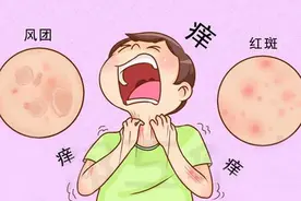 荨麻疹，痒痒痒！祛风散热，散寒化瘀，3个中药方，止痒又剜根图片