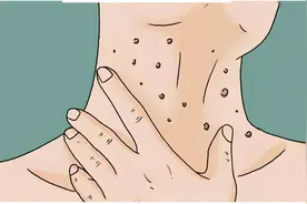 脖子和腋下的“小肉粒”是什么？能直接用手揪掉吗？告诉你答案图片