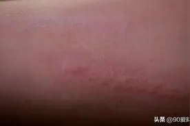 贪嘴的后果，就是荨麻疹又犯了，这两天浑身刺挠，感觉哪里都痒！图片