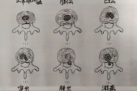 腰突不可乱投医！最全腰椎间盘突出分型，中医调理有妙招图片