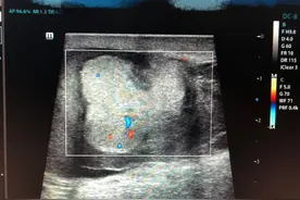 10岁男孩蛋蛋被同学一脚踢碎！医生坦言：每月接诊二三十例图片