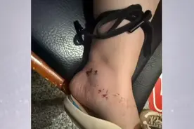 监控曝光！女子刚出电梯就被毒蛇咬伤，“黑血往外冒”，丈夫“教科书式”急救保命图片