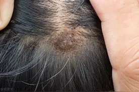 头皮上总是长疙瘩和脓包，是怎么回事？不是排毒，或是这4种疾病图片