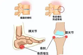 骨质增生的症状、发病原因、康复治疗和预防图片