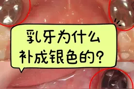 搞不懂，乳牙为什么补成银色的？图片
