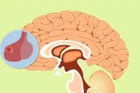 有这种面相的人，赶快去医院检查有没有脑垂体瘤！图片