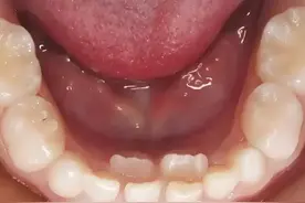 家长警惕——儿童换牙期间的“双排牙”图片