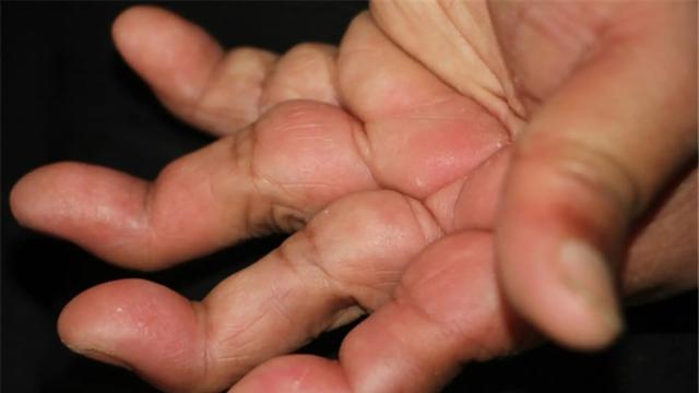 类风湿关节炎的典型表现，出现这些症状需警惕